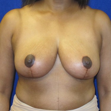 Breast Reduction- After