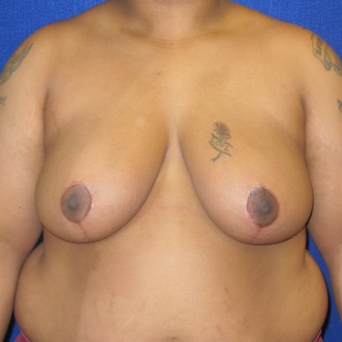 Breast Reduction- After