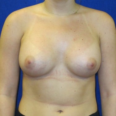 Breast Augmentation - After