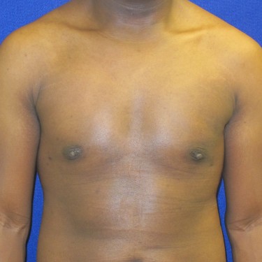 Male Breast Reduction - After
