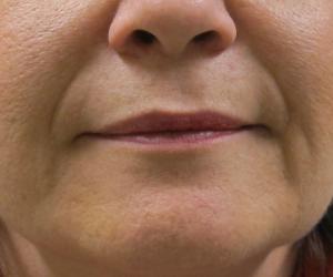 Case--1428 | Before Injectables