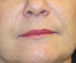 Case--1428 | After Injectables