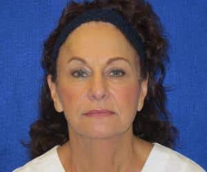 Case--2831 | After Fat Grafting