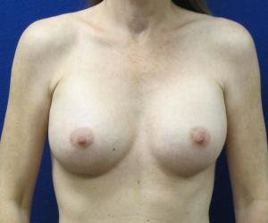 Breast Augmentation - After