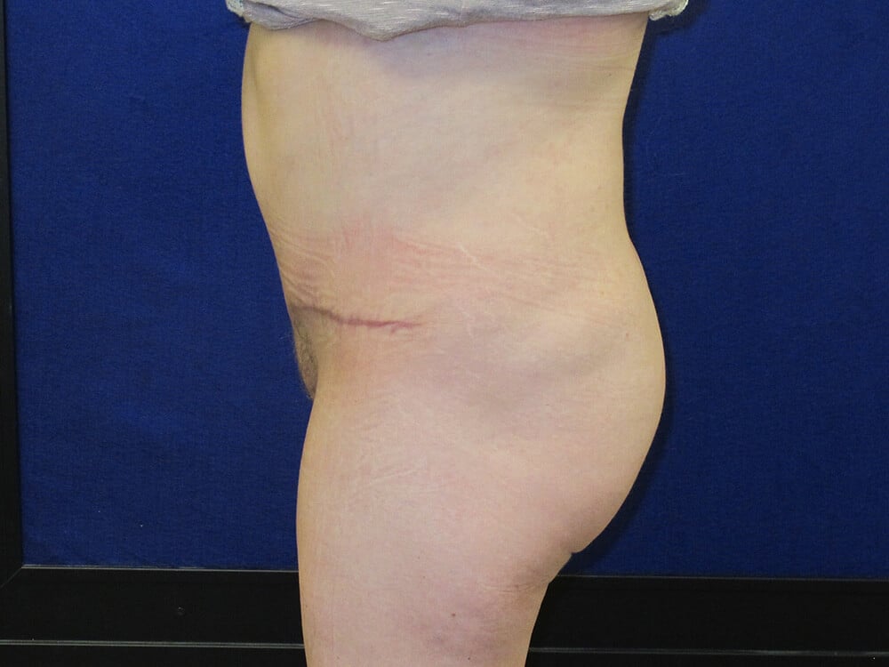 Case--1047 | After Body