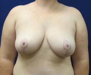Breast Lift - After