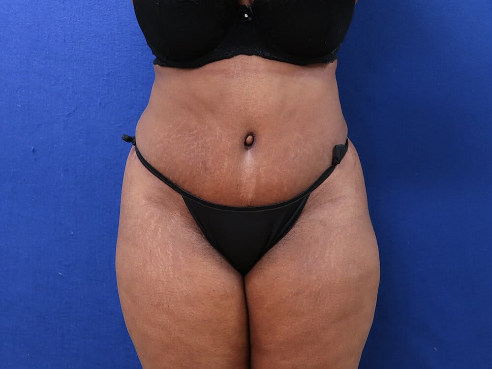 Case--9052 | After Tummy Tuck