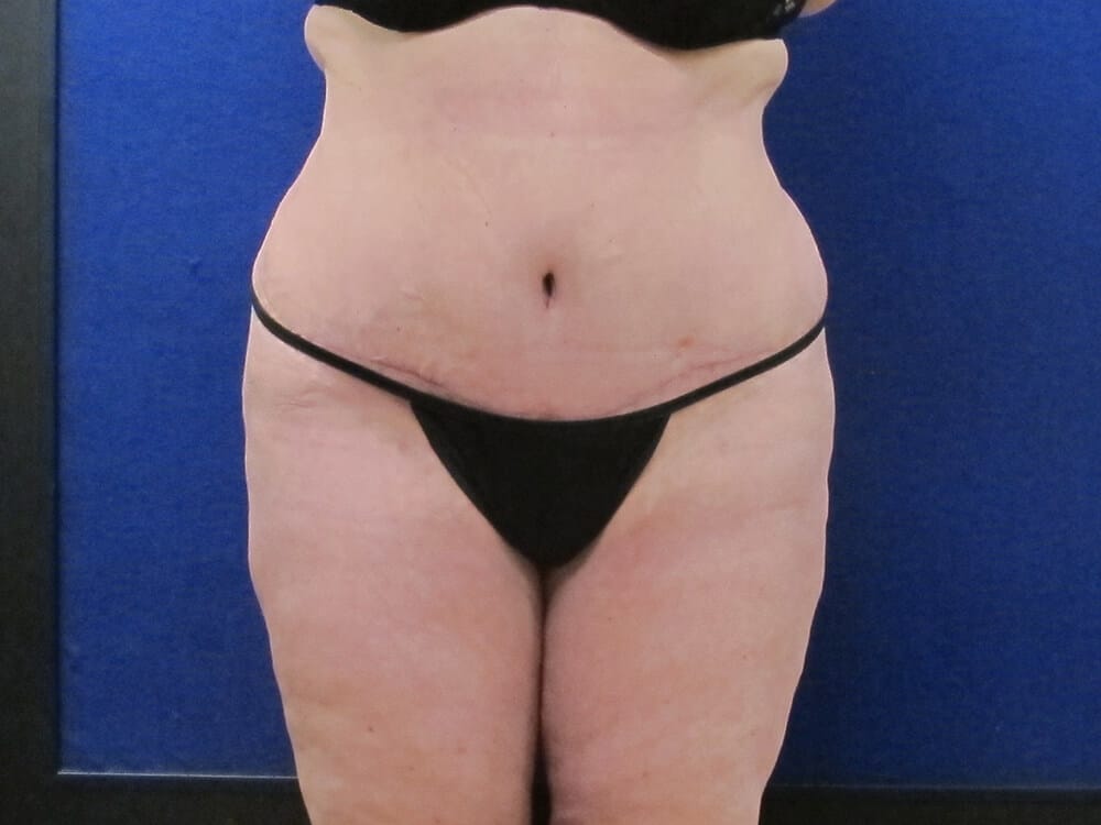 Case--1199 | After Tummy Tuck