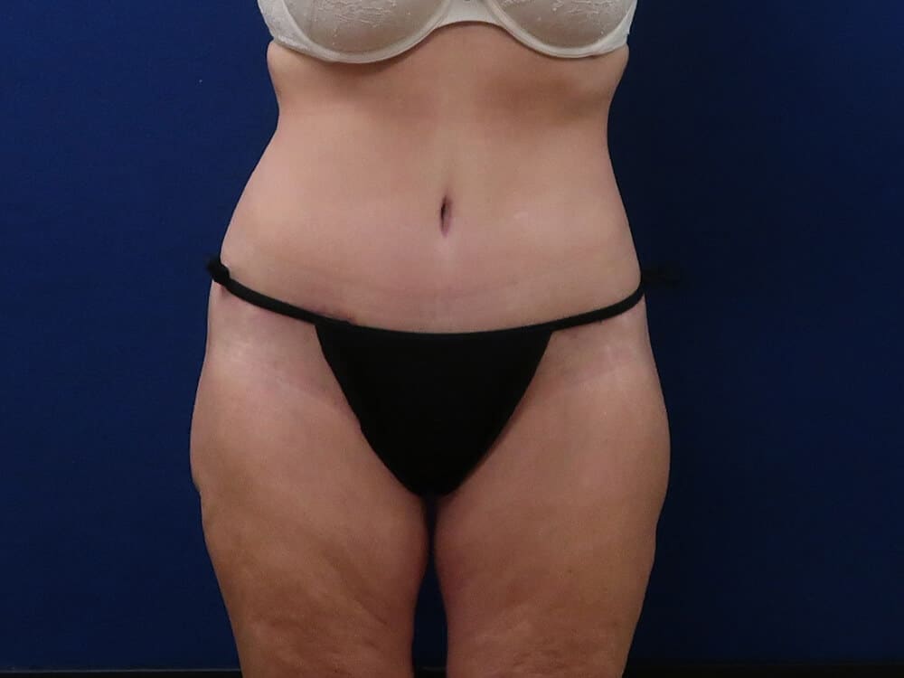 Case--8158 | After Lower Body Lift