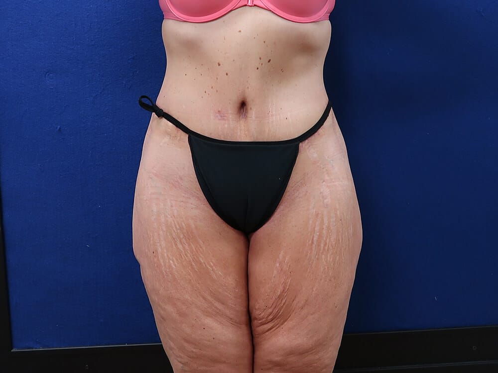 Case--7252 | After Lower Body Lift