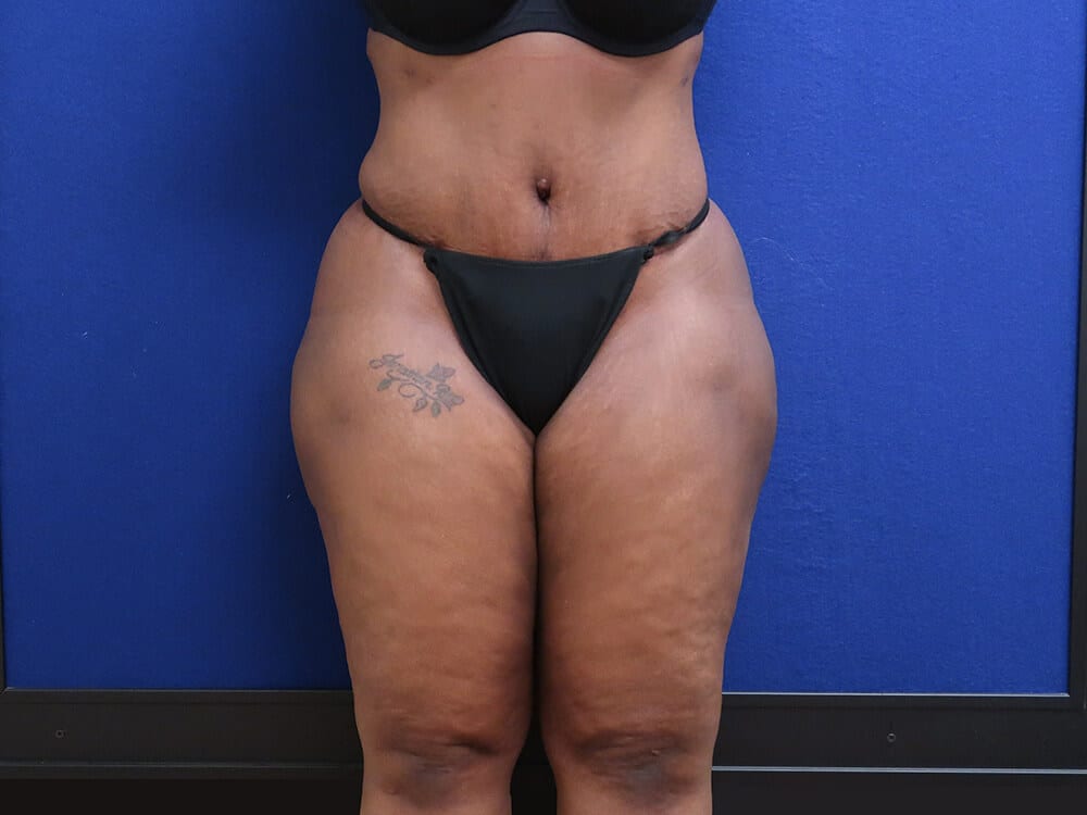 Case--4122 | After Tummy Tuck