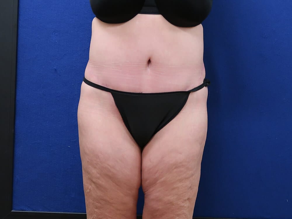 Case--9526 | After Lower Body Lift