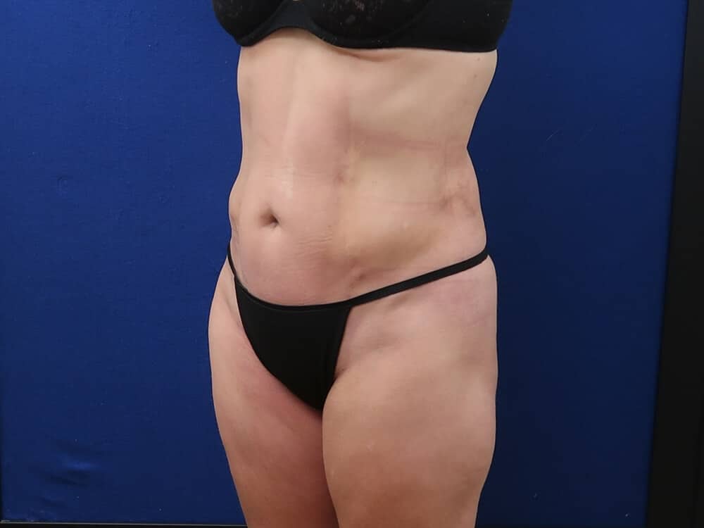 Case--1542 | After High Definition Liposuction