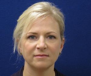 Case--6704 | After Injectables