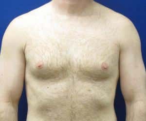 Case--6324 | Before Liposuction