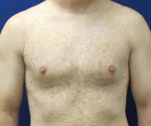 Case--6324 | After Liposuction