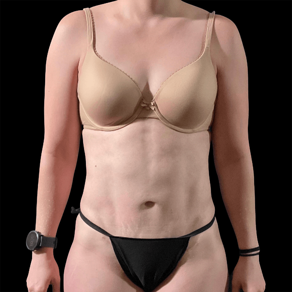 Case--9356 | After High Definition Liposuction