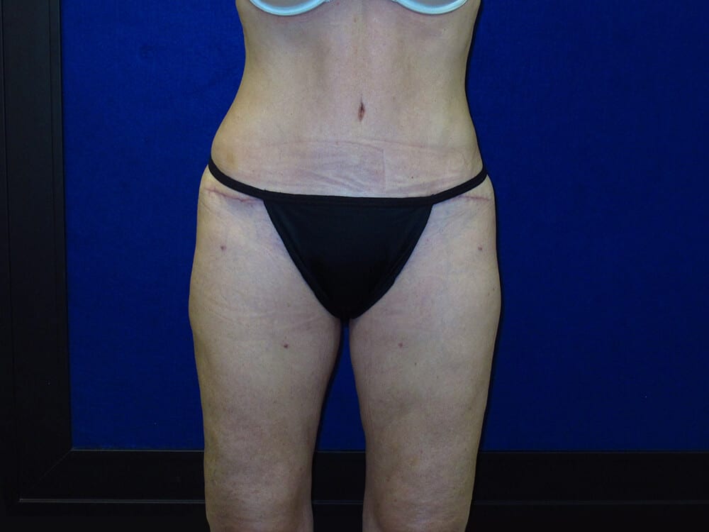 After Thigh Lift Liposuction
