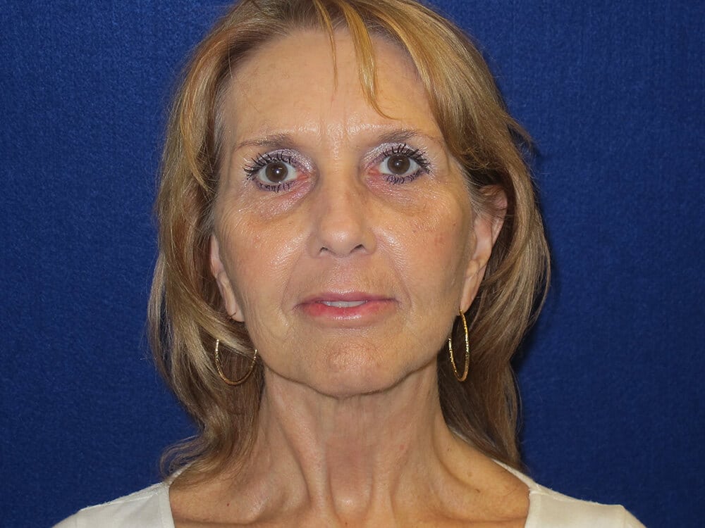 Case--1627 | After Fat Grafting