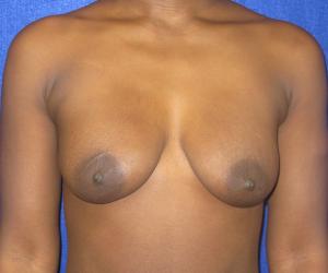 Breast Augmentation with Lift - Before