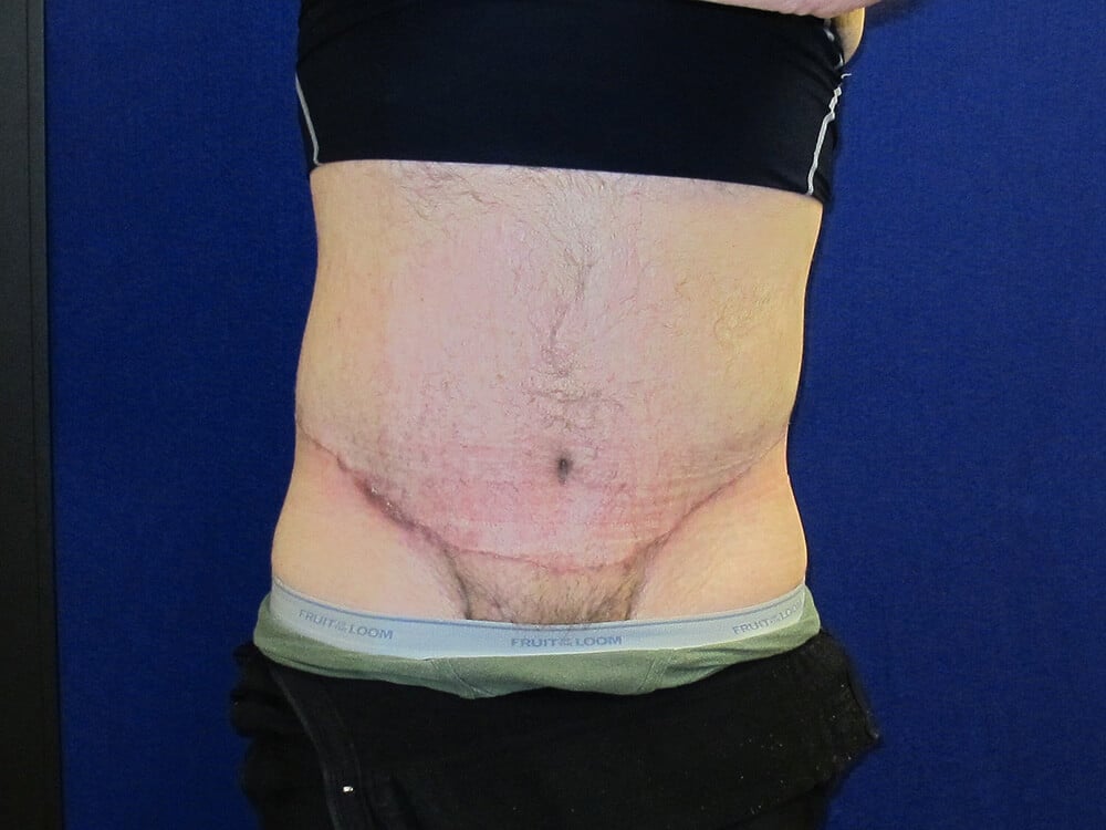 Case--3709 | After Body