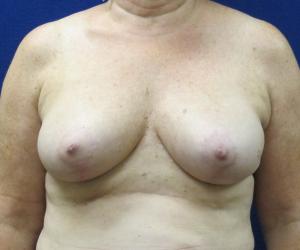 Breast Reduction- After