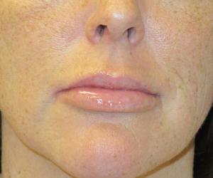 Case--3912 | After Fat Grafting