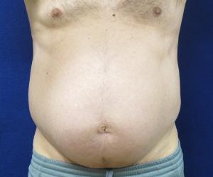 Case--2045 | Before Liposonix