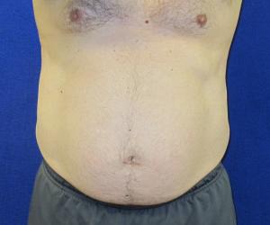 Case--2045 | After Liposonix