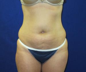 Case--4720 | Before Tummy Tuck