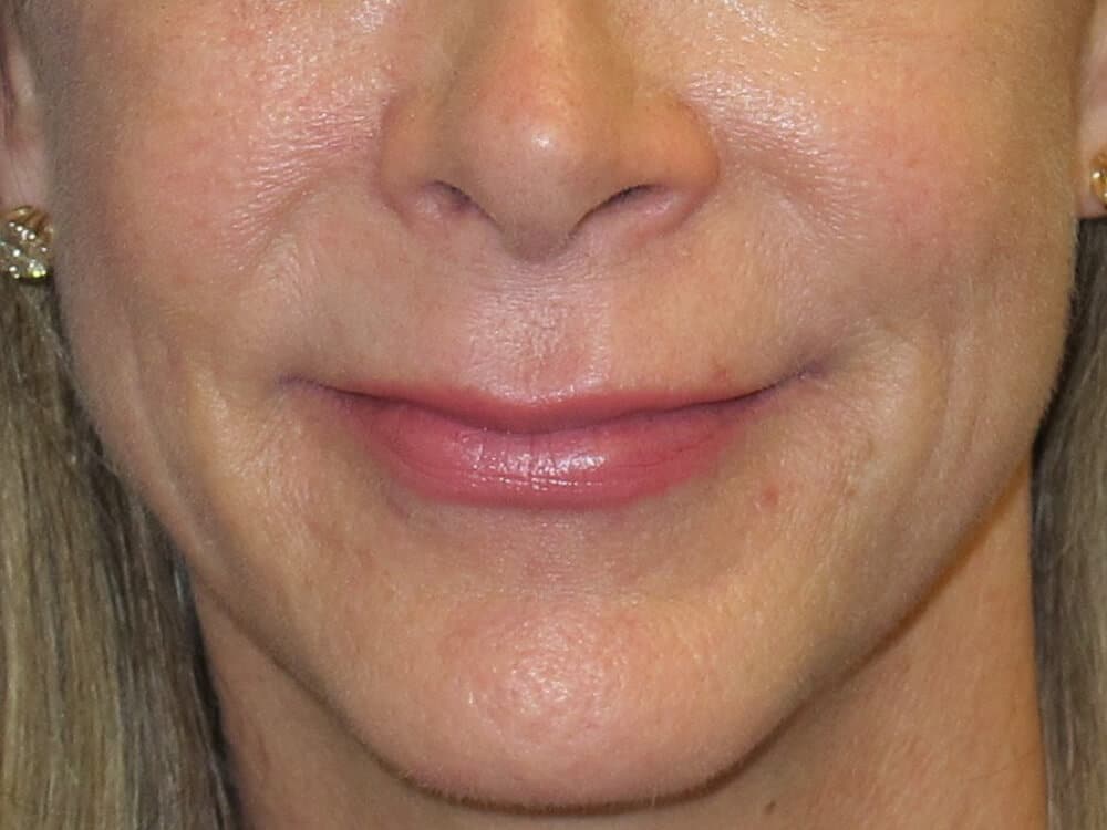 Case--4796 | After Injectables