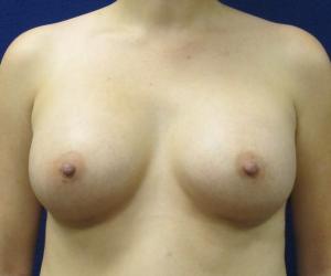 Breast Augmentation - After
