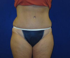 Case--7691 | After Tummy Tuck