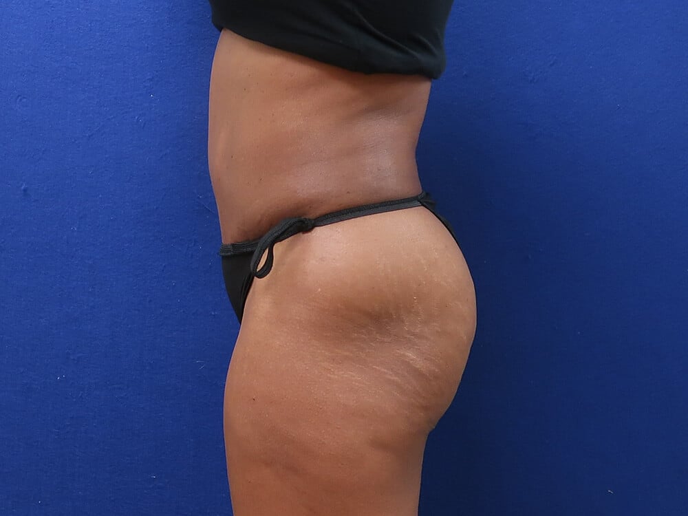 Case--7850 | After Tummy Tuck