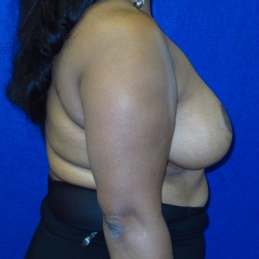 Breast Reduction- After