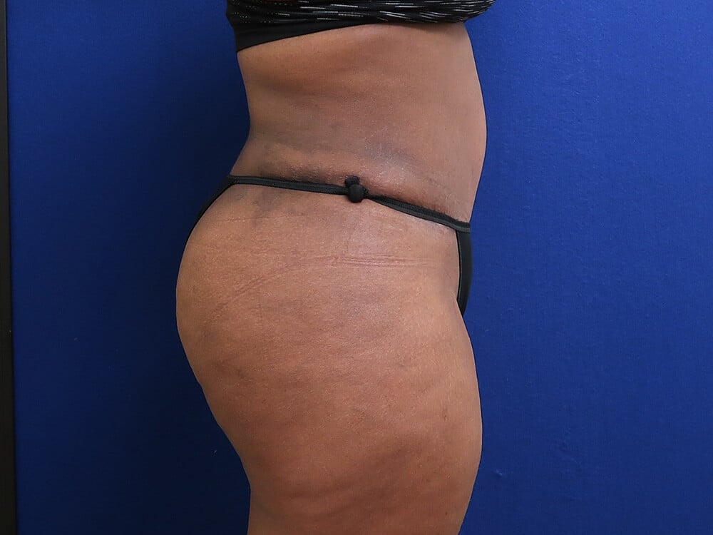 Case--4576 | After Tummy Tuck