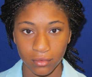 Case--3318 | Before Face