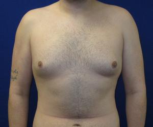 Male Breast Reduction - Before