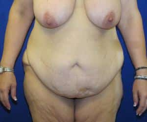 Case--4570 | Before Tummy Tuck