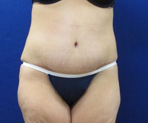 Case--4570 | After Tummy Tuck