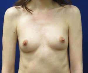 Breast Augmentation - Before