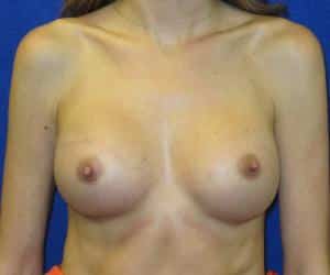 Breast Augmentation - After
