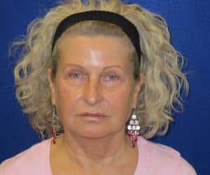 Case--7853 | Before Fat Grafting