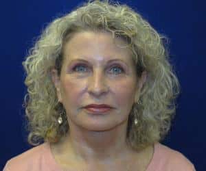 Case--7853 | After Fat Grafting