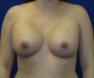 Breast Augmentation - After