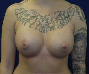Breast Augmentation - After