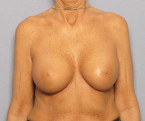 Breast Augmentation - After