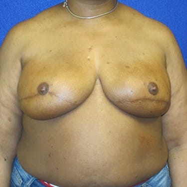 Breast Reconstruction- After