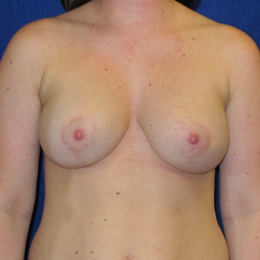 Breast Augmentation with Lift - After