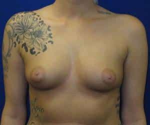 Breast Augmentation - Before